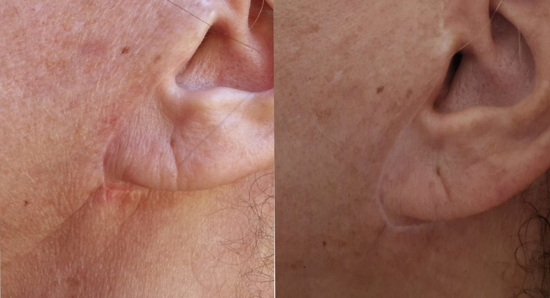 Plasma froid plus
